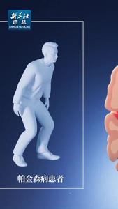 Científicos chinos identifican red cerebral patológica central de enfermedad de Parkinson